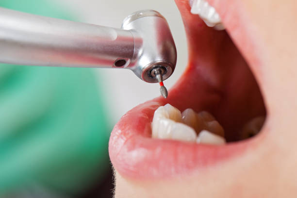 Best Emergency Broken Tooth Repair in Springtown, TX